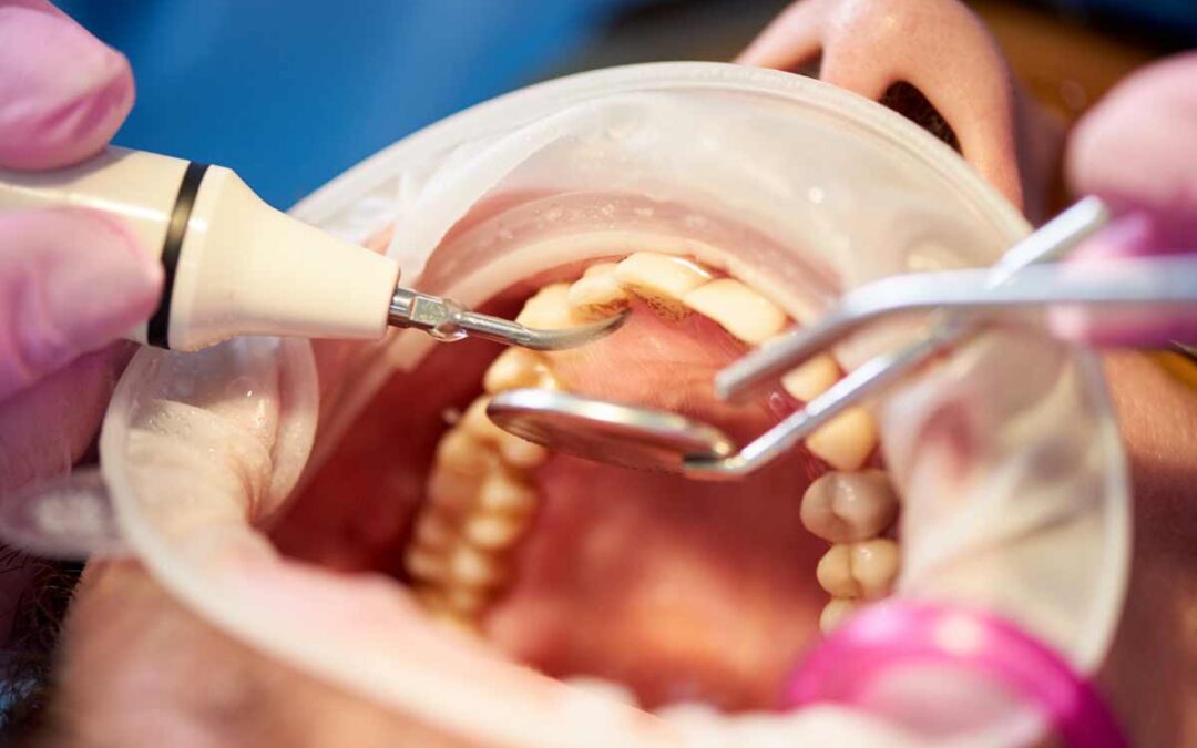 ¿Qué es la anquilosis dental?