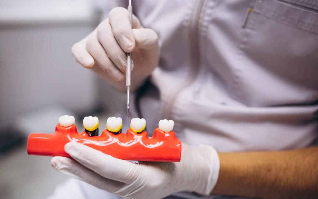 ¿Qué es la periodontitis?