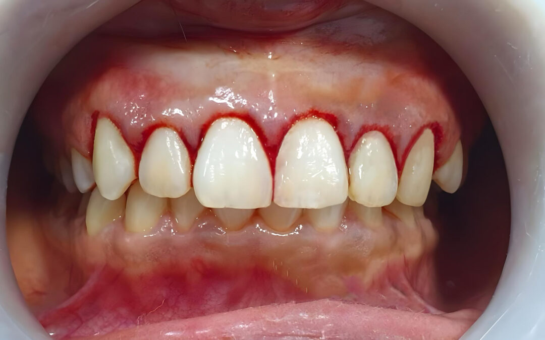 Encías sanas y rosadas, prevención de gingivitis, clínica Mundisalud Amurrio y Llodio