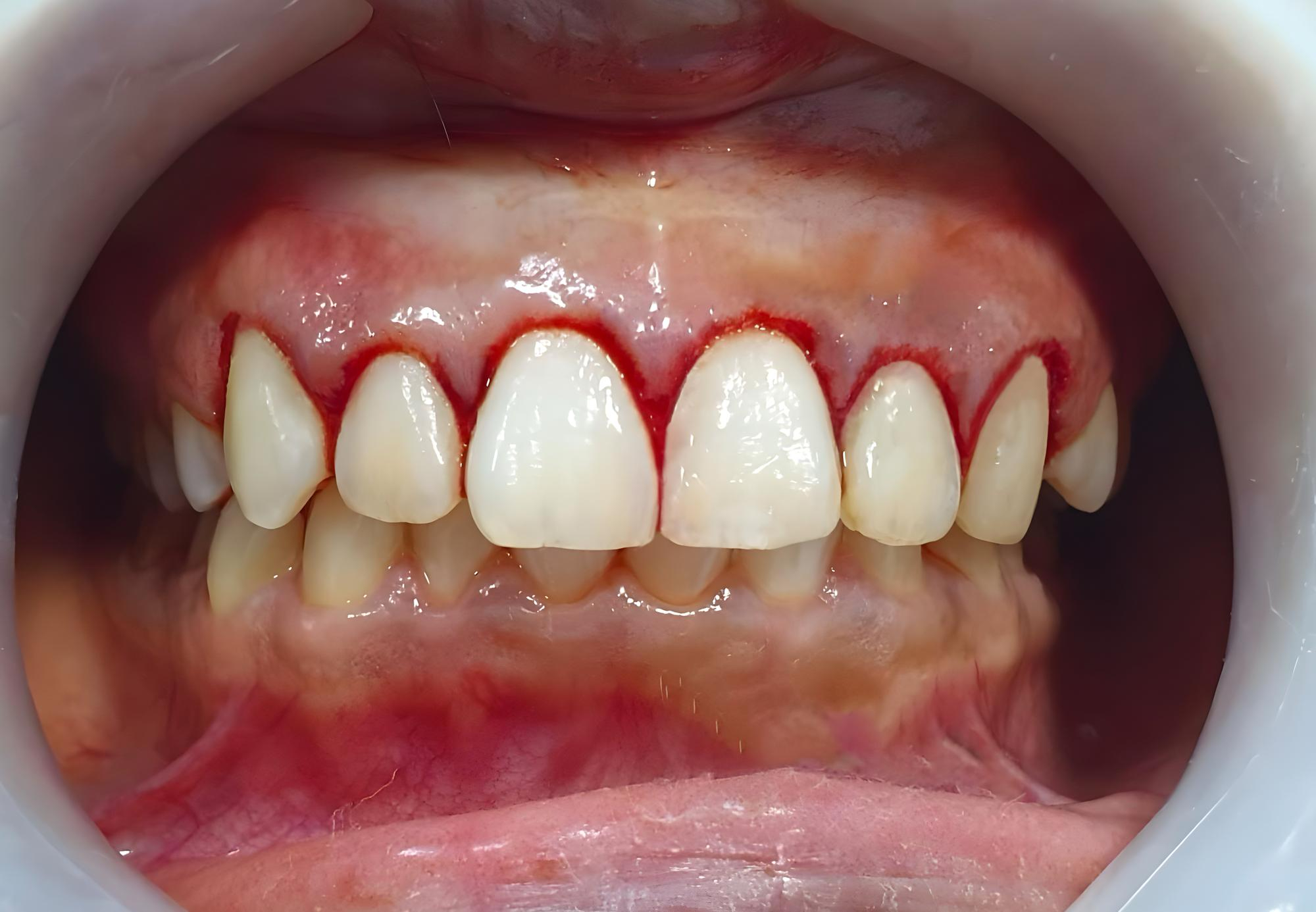 Encías sanas y rosadas, prevención de gingivitis, clínica Mundisalud Amurrio y Llodio