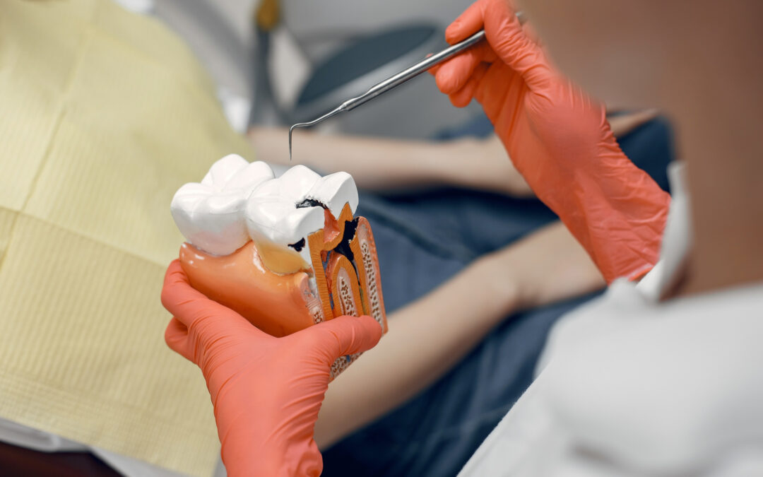 Diente restaurado con empaste de composite blanco, clínica dental Mundisalud Amurrio y Llodio