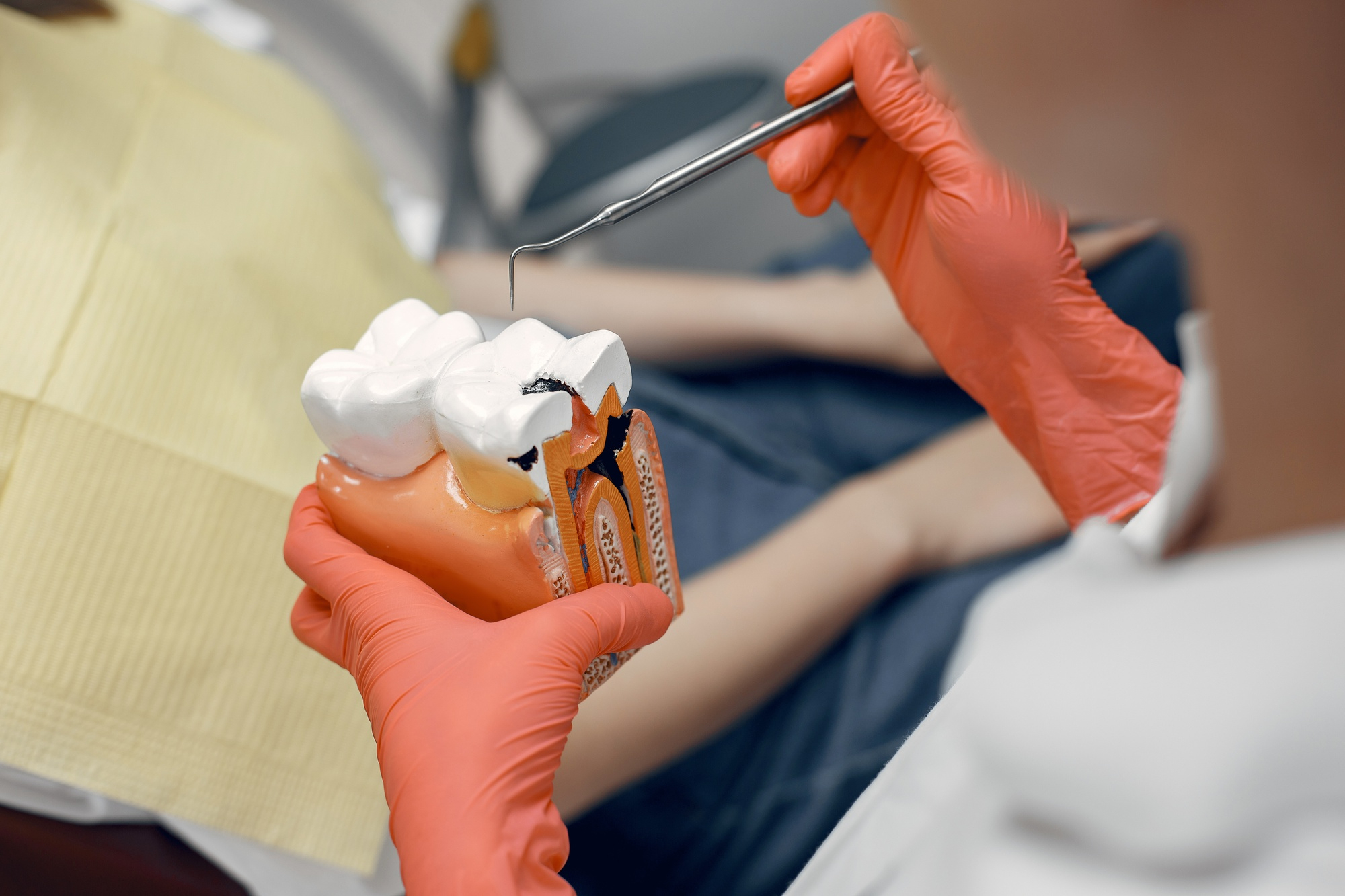 Diente restaurado con empaste de composite blanco, clínica dental Mundisalud Amurrio y Llodio