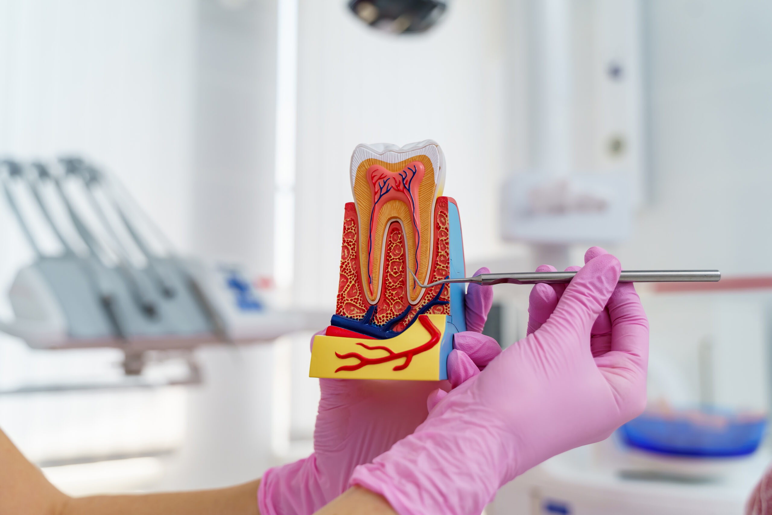Representación del interior de un diente durante una endodoncia, clínica dental Mundisalud Amurrio Llodio